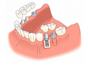 Dental Implants Restoration Davidsville, Johnstown, & Somerset, PA