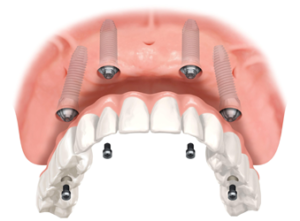 Dental Implants Restoration Davidsville, Somerset, Johnstown, PA | Dr. Ernest Mantini