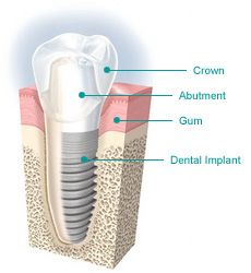 Dental Implants Restoration Davidsville, Somerset, Johnstown, PA