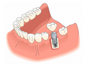 Dental Implants Restoration Davidsville, Johnstown, & Somerset, PA