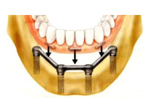 Dental Implants Restoration Davidsville, Johnstown, Somerset, PA | Drs. Ernest and Rocco Mantini