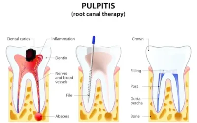 Do I Need A Root Canal?