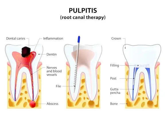Root Canal Treatment Johnstown & Davidsville PA